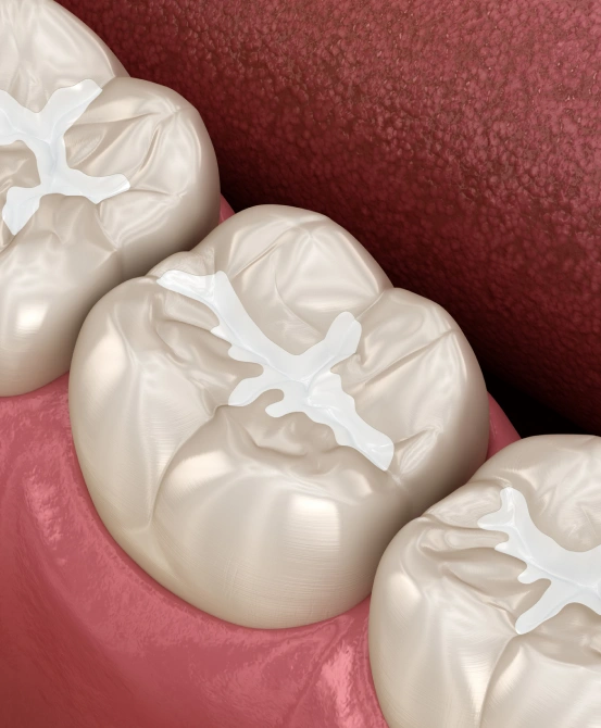 Dental Sealants in Muscatine, IA