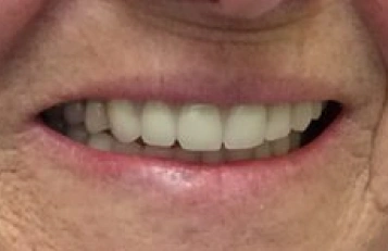After cavity repair with natural-looking dental filling