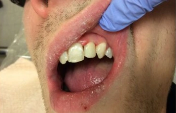 After tooth filling treatment improving smile appearance