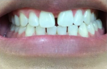 After teeth whitening results