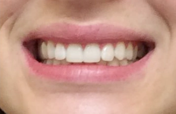 Smile after professional teeth whitening