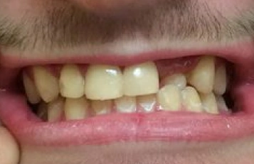 After dental filling treatment showing restored tooth structure