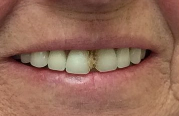 Before cavity repair with natural-looking dental filling