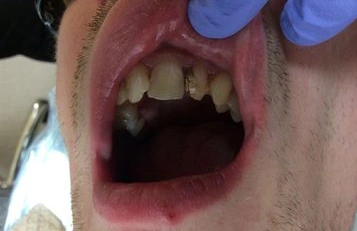 Before tooth filling treatment improving smile appearance