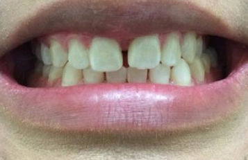 Before teeth whitening results