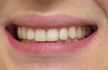 Smile before professional teeth whitening