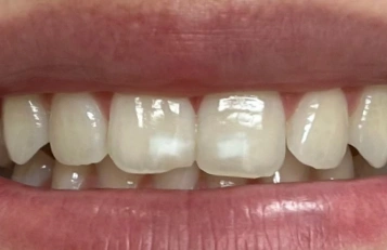Before Icon Caries Treatment