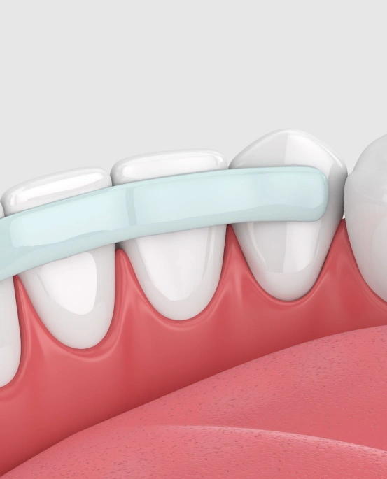 Dental bonding treatment repairing and reshaping a tooth