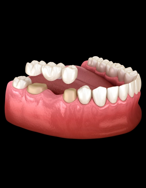 Custom dental bridge used to replace missing teeth