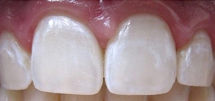 Close-up of front teeth after icon caries treatment