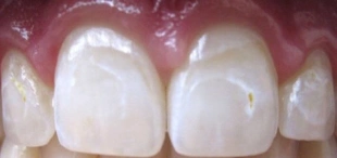 Close-up of front teeth before icon caries treatment