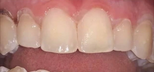 Front teeth after icon caries treatment with improved enamel appearance