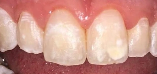 Front teeth before icon caries treatment showing enamel lesions