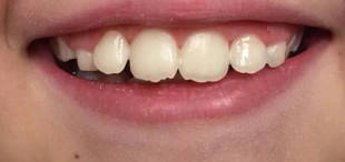 Smile after icon caries treatment with improved appearance