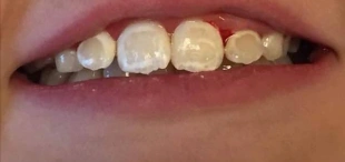 Smile before icon caries treatment showing white spot lesions