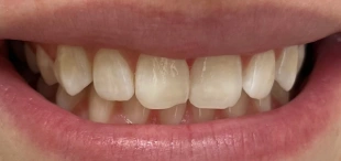 Icon caries treatment after reducing white spot lesions on front teeth
