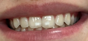 Icon caries treatment before showing white spot lesions on front teeth