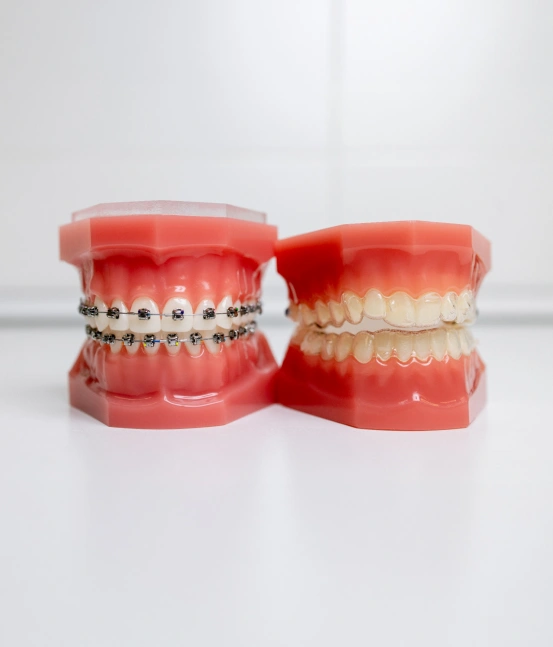 Orthodontic treatment with braces for straighter teeth