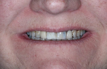 Dentures After