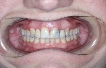 Dentures Before