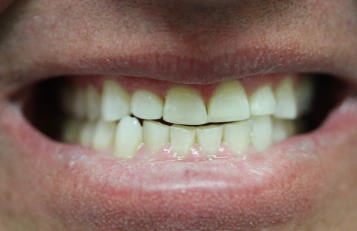 Chipped tooth after