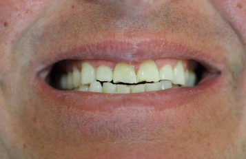 Chipped tooth before