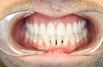 Dentures after
