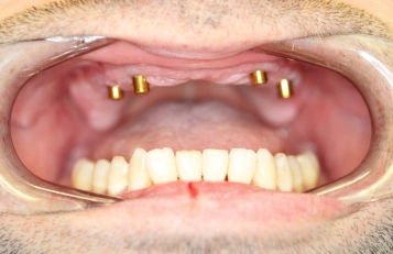 Dentures before