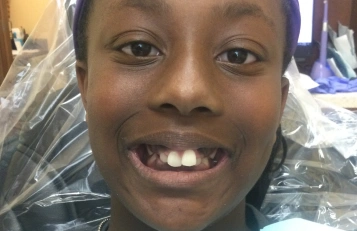 Full mouth Before