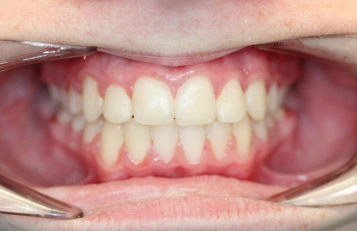 Porcelain Veneers after