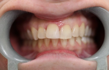 Porcelain Veneers before