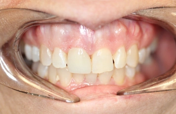 Upper Dentures after