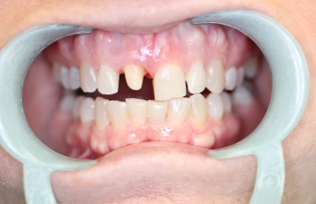 Upper Dentures before