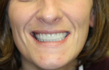 Teeth Whitening before