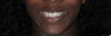 Patient's full mouth smile after dental treatment at Muscatine dental practice.
