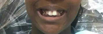 Patient displaying full mouth smile before dental treatment in Muscatine, Iowa.