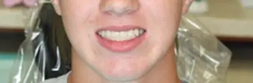 Smiling patient displaying results after Invisalign teeth straightening treatment.