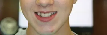 Close-up of patient's smile showing teeth before Invisalign treatment in Muscatine.