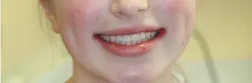 Close-up of patient's bright, straight smile after orthodontic treatment in Muscatine.