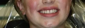 Young patient smiling, showing teeth before orthodontic treatment in Muscatine.